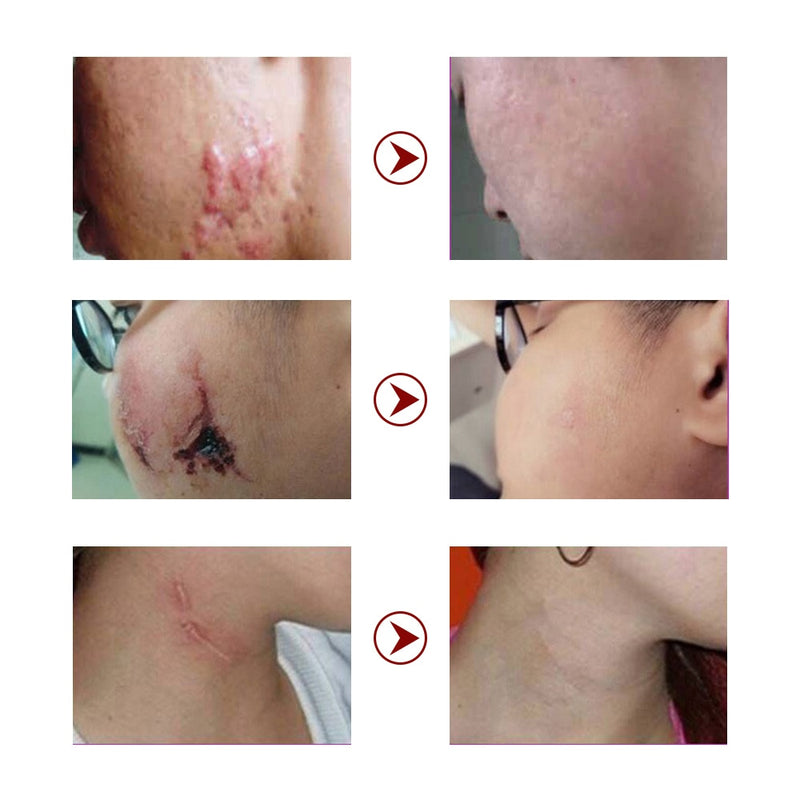 Acne Scar Removal Cream Skin Care Stretch Marks Treatment Pimples Spots Repair Gel Whitening Moisturizer Smooth Beauty Cosmetics